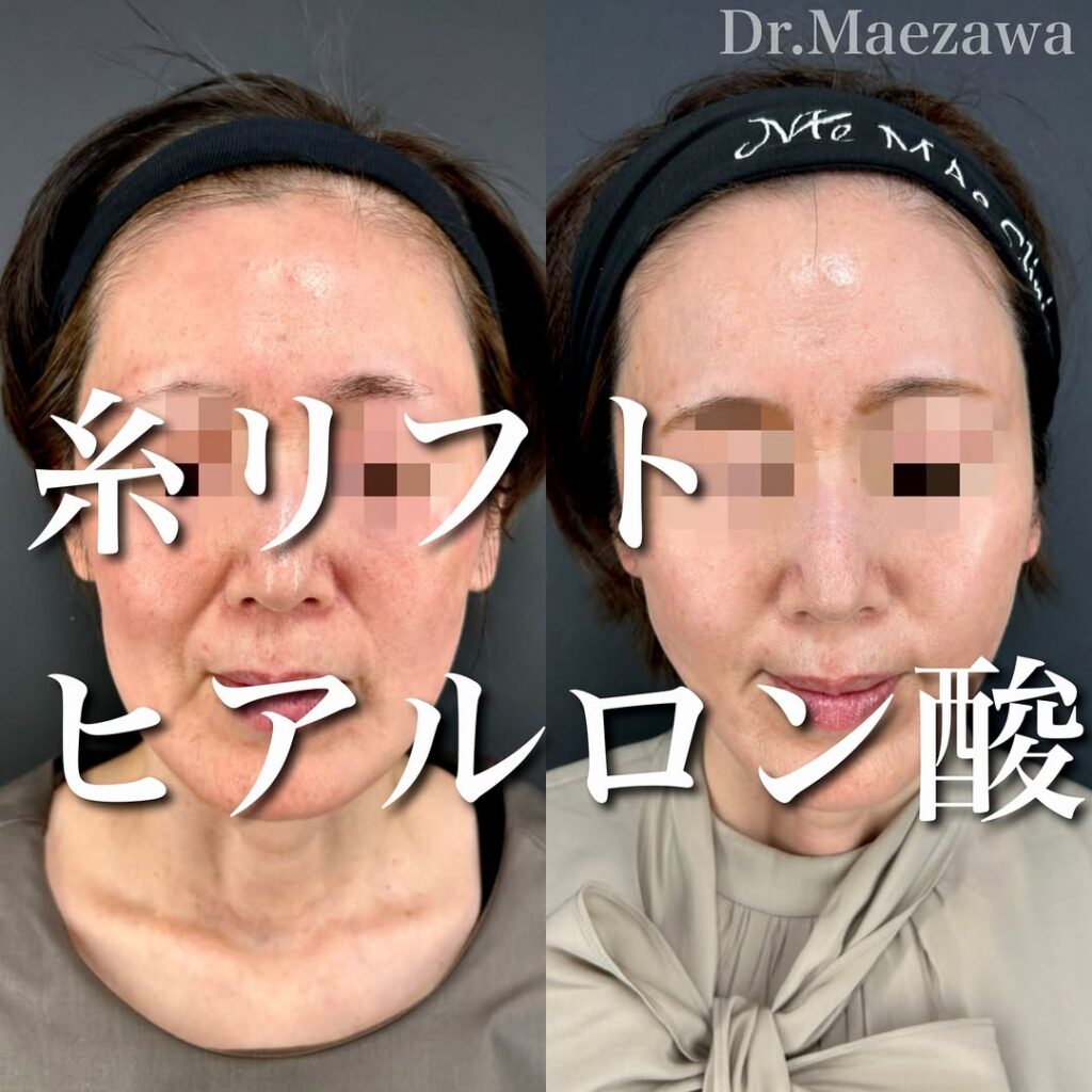 アルテミスリフト(左右5本ずつ)
ヒアルロン酸注入(頬コケ・ほうれい線〜マリオネットライン・顎/合計2cc)
術後経過:1ヶ月の症例