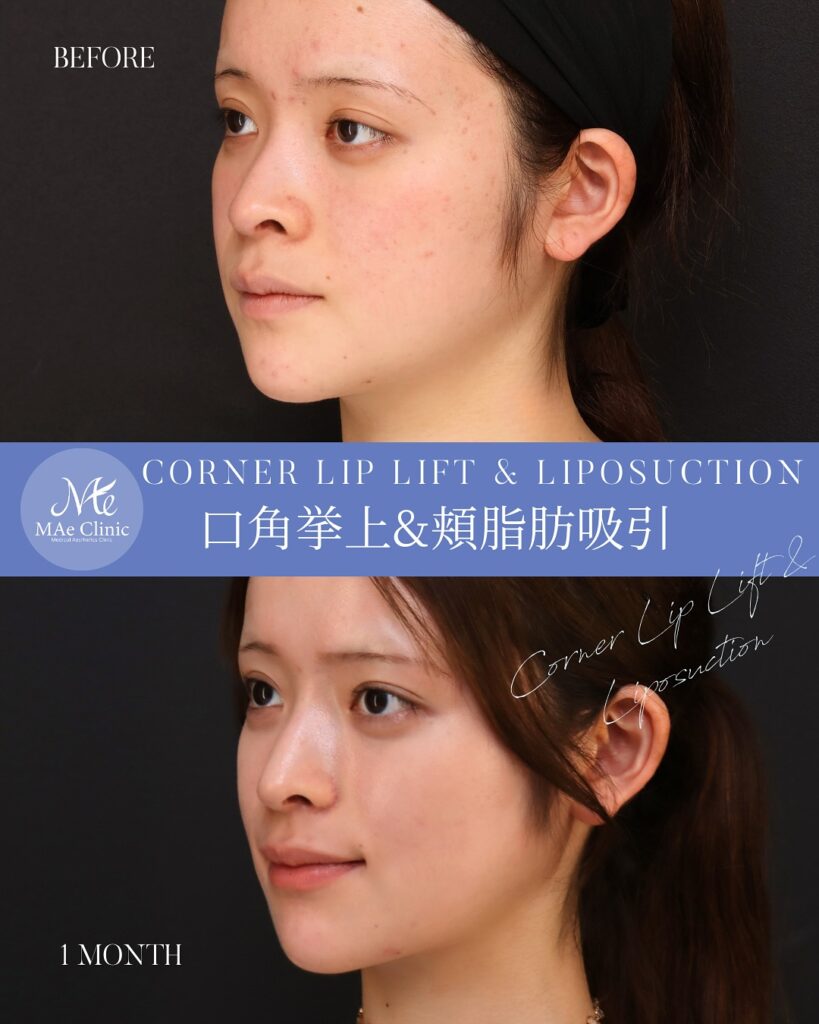 口角挙上
頬脂肪吸引
1ヶ月後　木下恵里沙医師症例