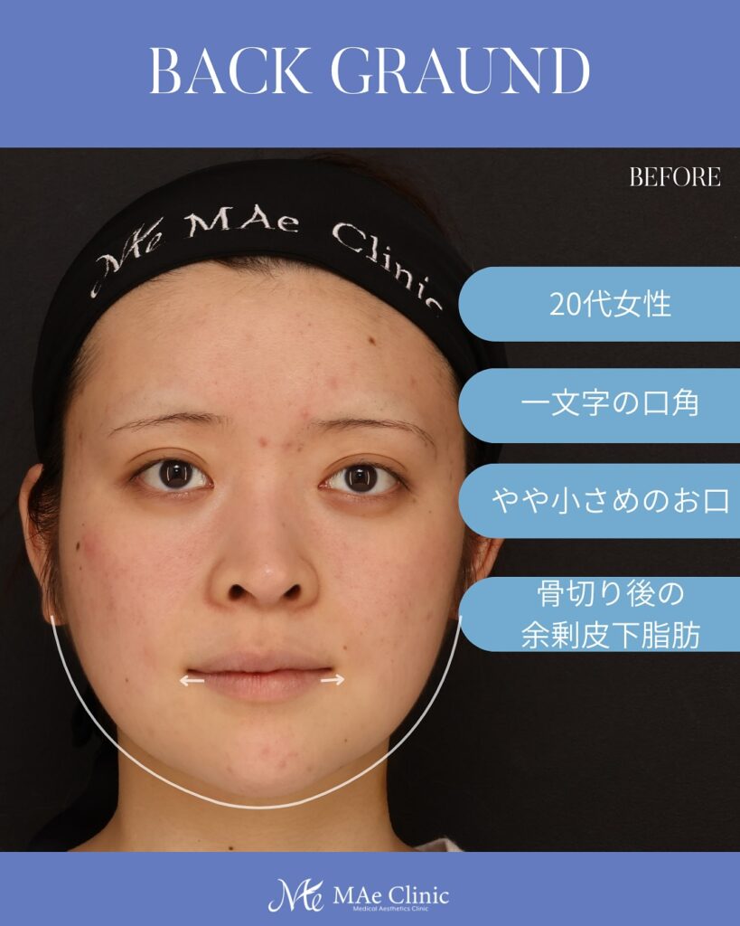 口角挙上 頬脂肪吸引 1ヶ月後　木下恵里沙医師症例