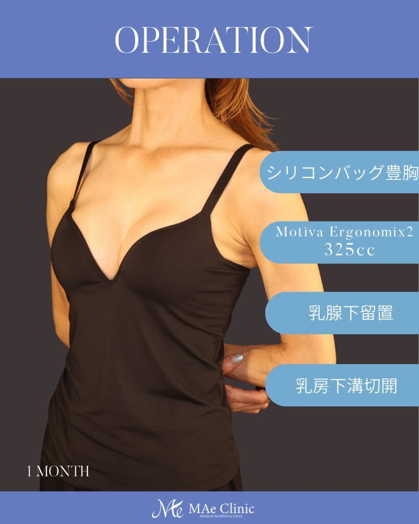 シリコンバッグ豊胸（Motiva Ergonomix2 325ml／乳腺下留置） 術後経過：1ヶ月　木下恵里沙医師症例