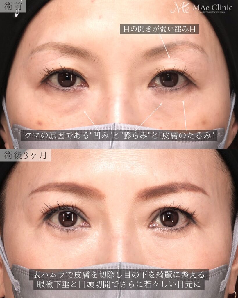 眼瞼下垂、目頭切開、表ハムラ　症例　前之園健太医師