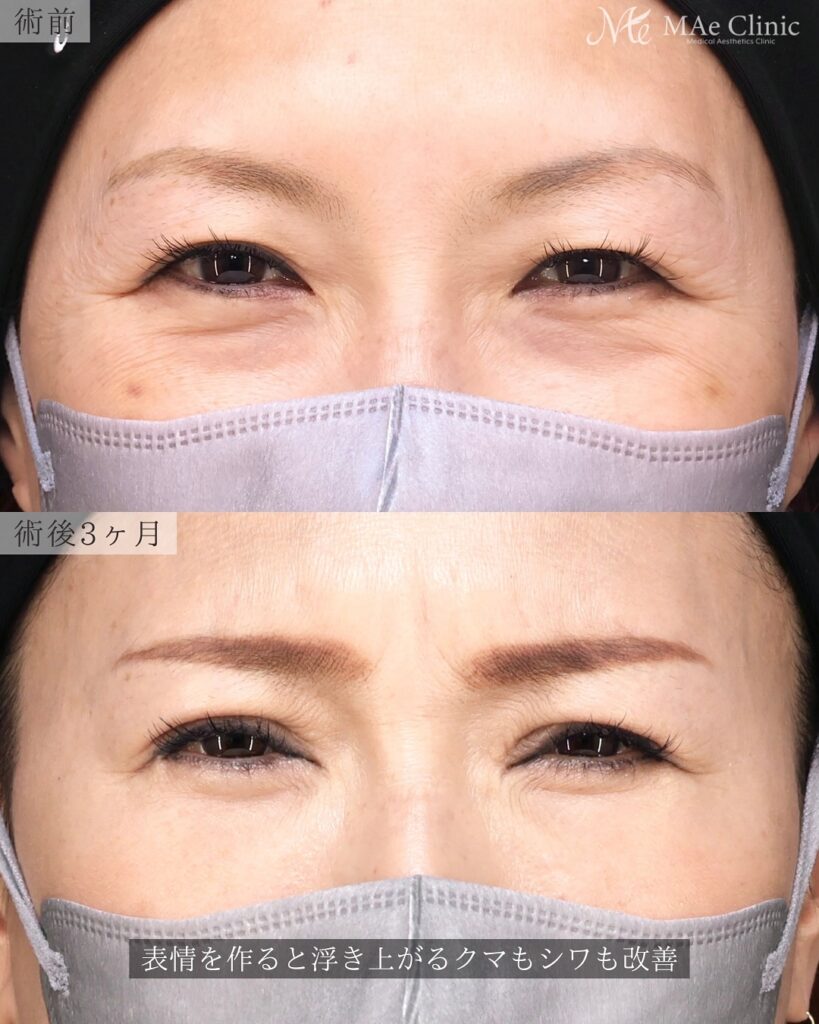 眼瞼下垂、目頭切開、表ハムラ　症例　前之園健太医師