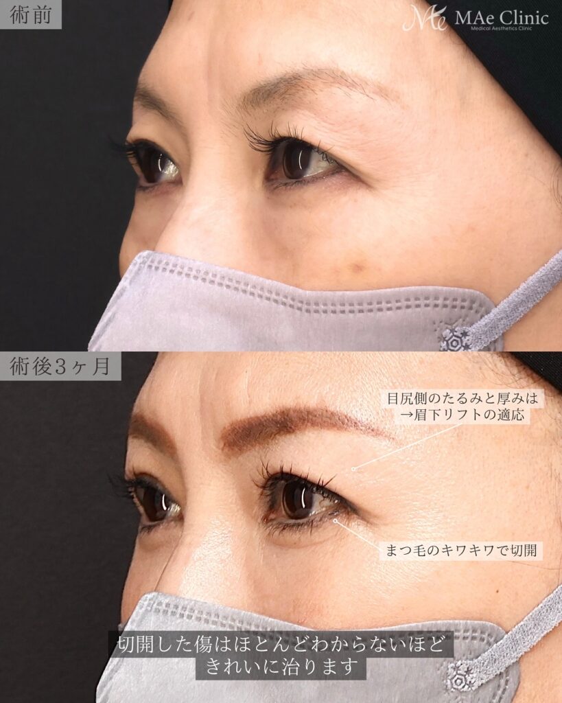 眼瞼下垂、目頭切開、表ハムラ　症例　前之園健太医師
