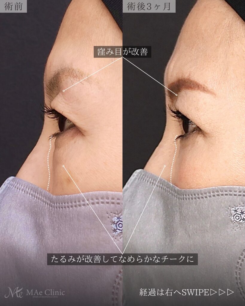 眼瞼下垂、目頭切開、表ハムラ　症例　前之園健太医師