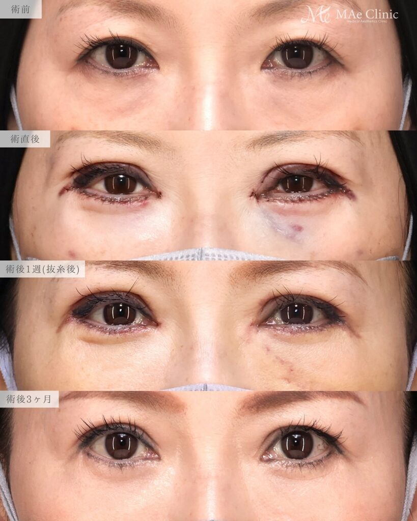 眼瞼下垂、目頭切開、表ハムラ　症例　前之園健太医師