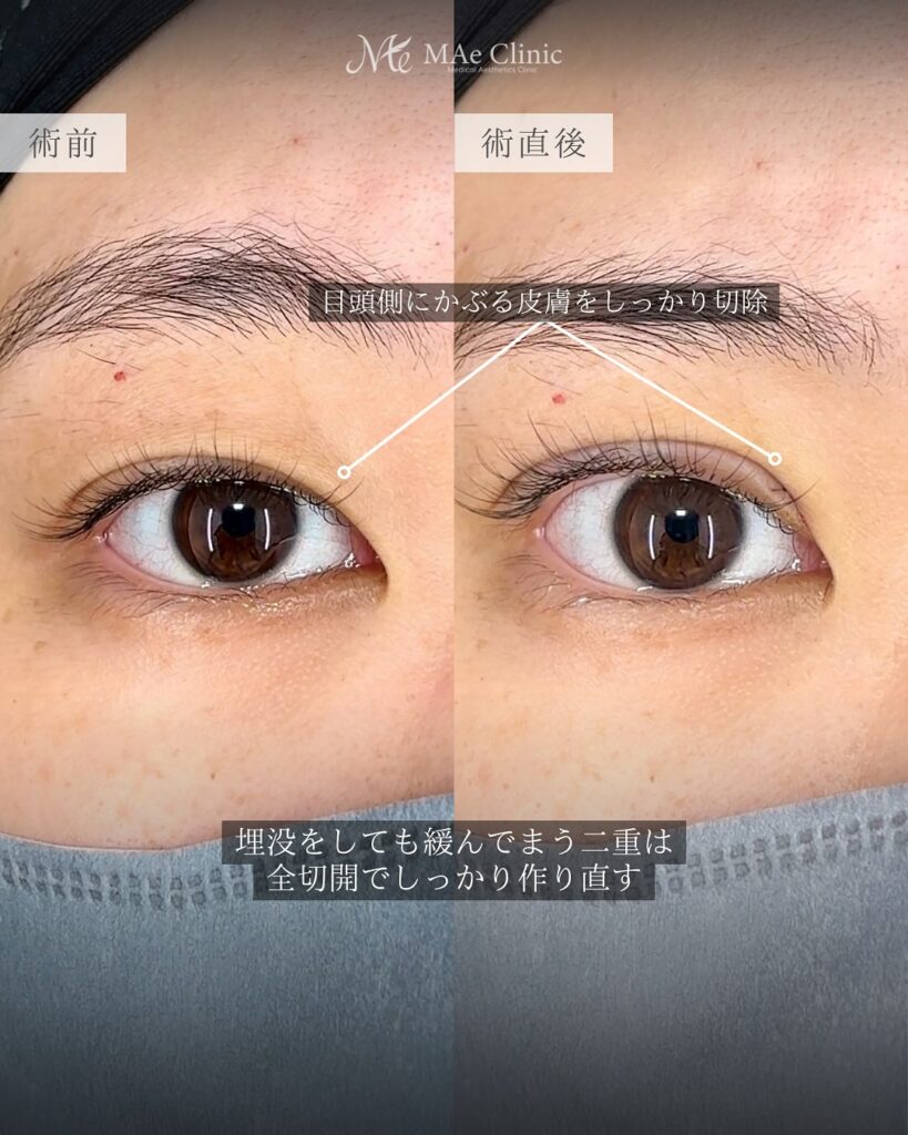 二重全切開　症例　前之園健太医師