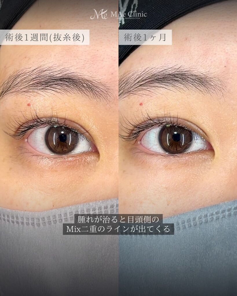 二重全切開　症例　前之園健太医師
