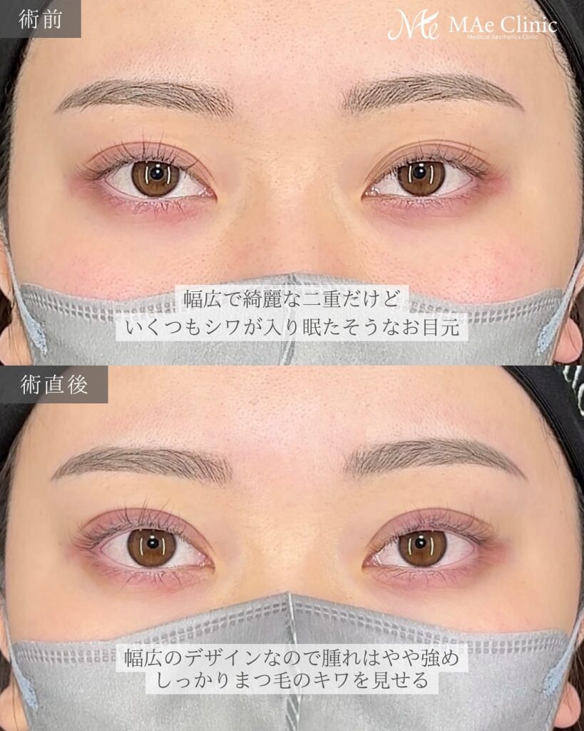 二重埋没　症例　前之園健太医師