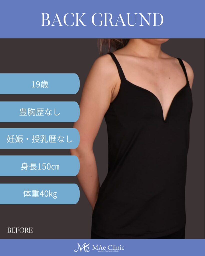 ・シリコンバッグ豊胸（Motiva Ergonomix2 250cc） ・乳腺下留置 ・乳房下溝切開 経過1ヶ月　木下恵里沙医師症例