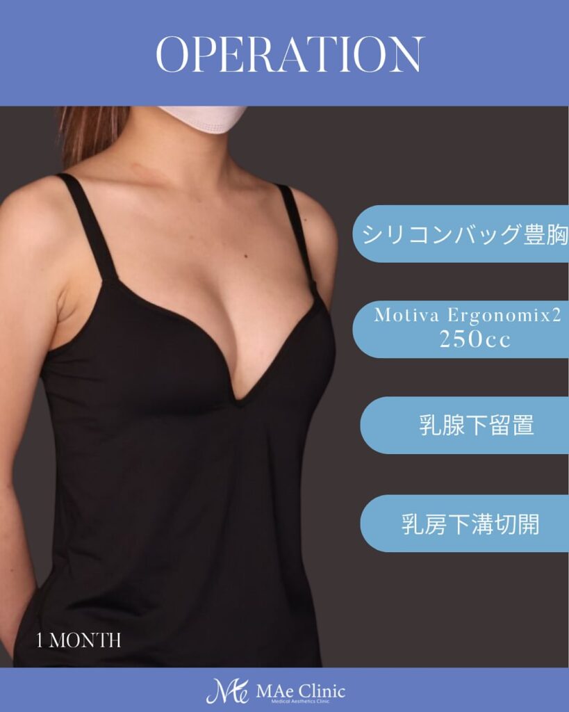 ・シリコンバッグ豊胸（Motiva Ergonomix2 250cc） ・乳腺下留置 ・乳房下溝切開 経過1ヶ月　木下恵里沙医師症例