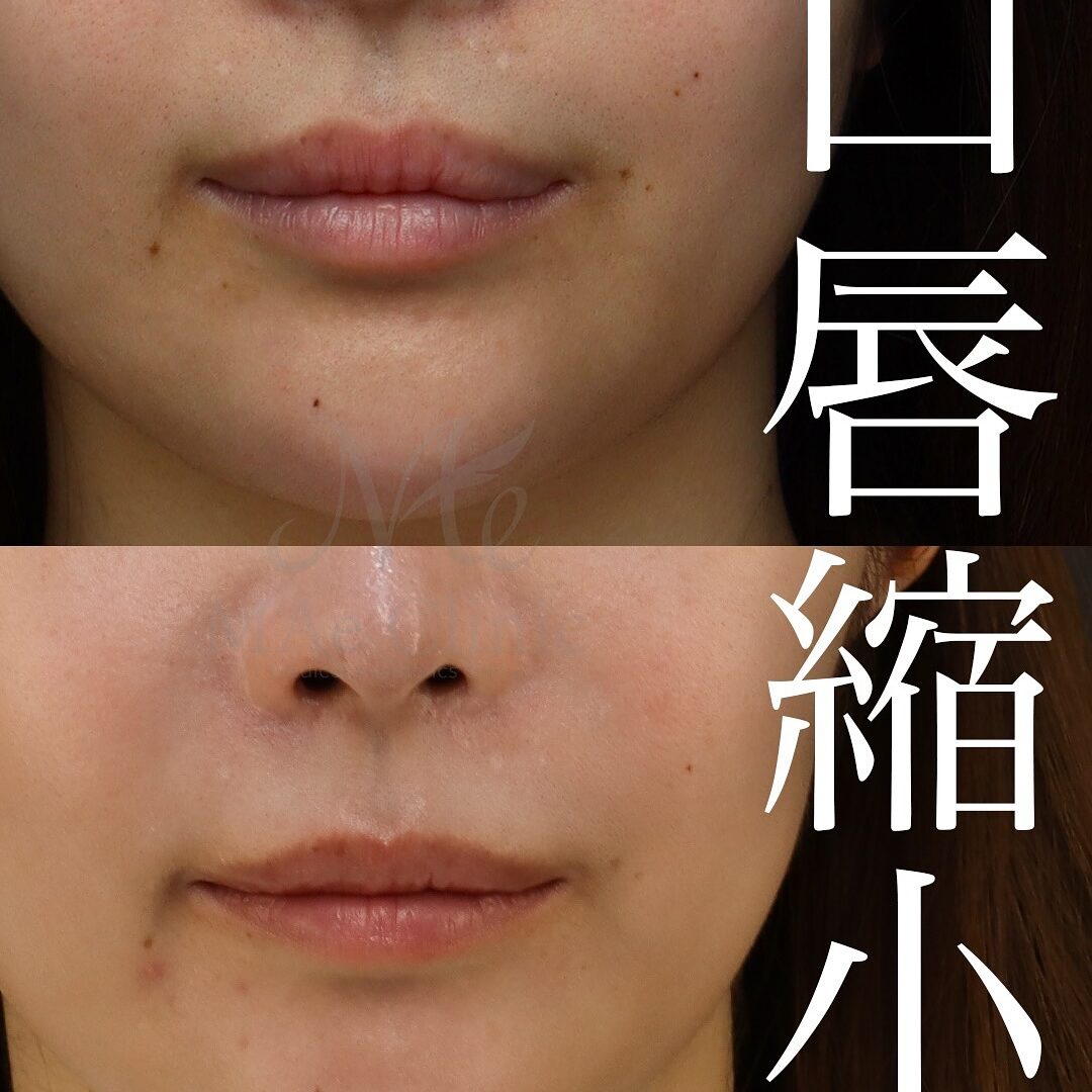 たらこ唇修正 | MAe Clinic【マエクリ】