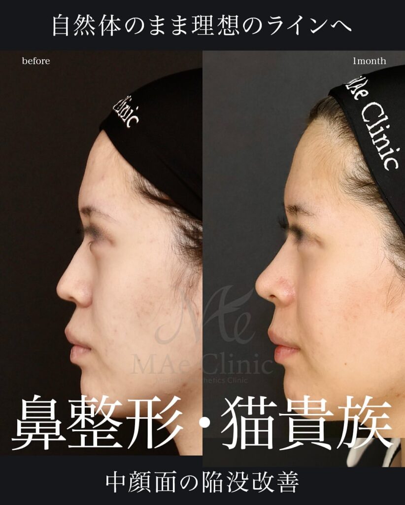 ・鼻中隔延長(肋軟骨)
・鼻尖形成
・鼻尖軟骨移植
・猫貴族手術(肋軟骨)
望月正人医師症例