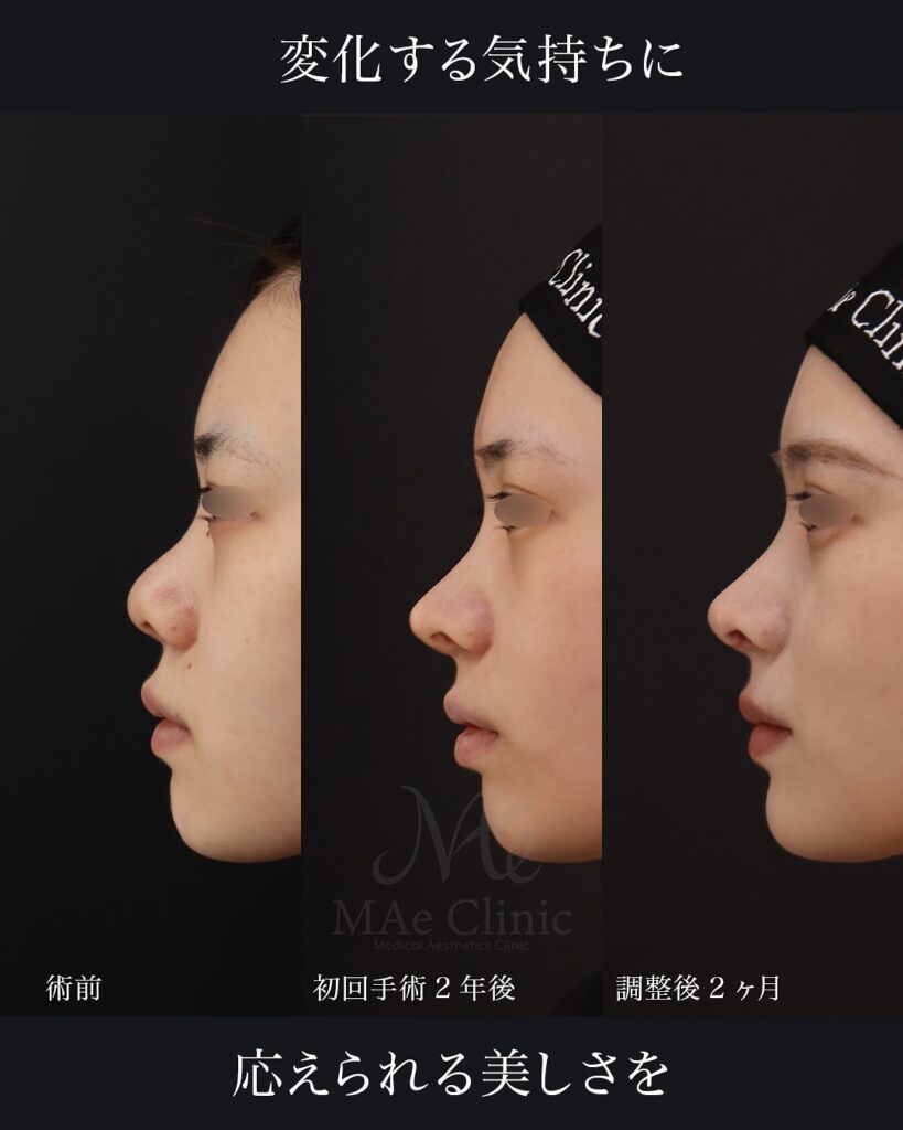 鼻中隔延長(肋軟骨)+鼻尖形成+鼻尖軟骨移植+猫貴族手術(肋軟骨) 鼻尖形成+鼻尖軟骨移植 前田翔医師症例