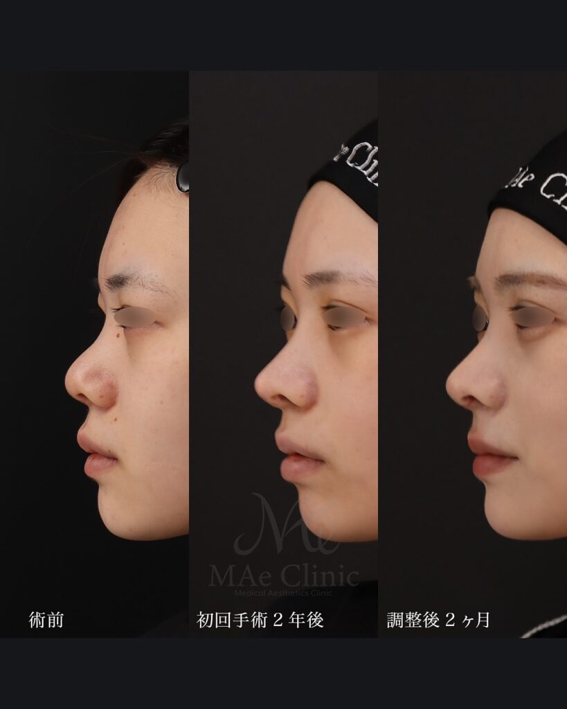 鼻中隔延長(肋軟骨)+鼻尖形成+鼻尖軟骨移植+猫貴族手術(肋軟骨) 鼻尖形成+鼻尖軟骨移植 前田翔医師症例