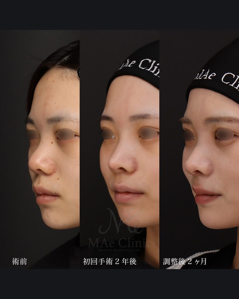 鼻中隔延長(肋軟骨)+鼻尖形成+鼻尖軟骨移植+猫貴族手術(肋軟骨) 鼻尖形成+鼻尖軟骨移植 前田翔医師症例