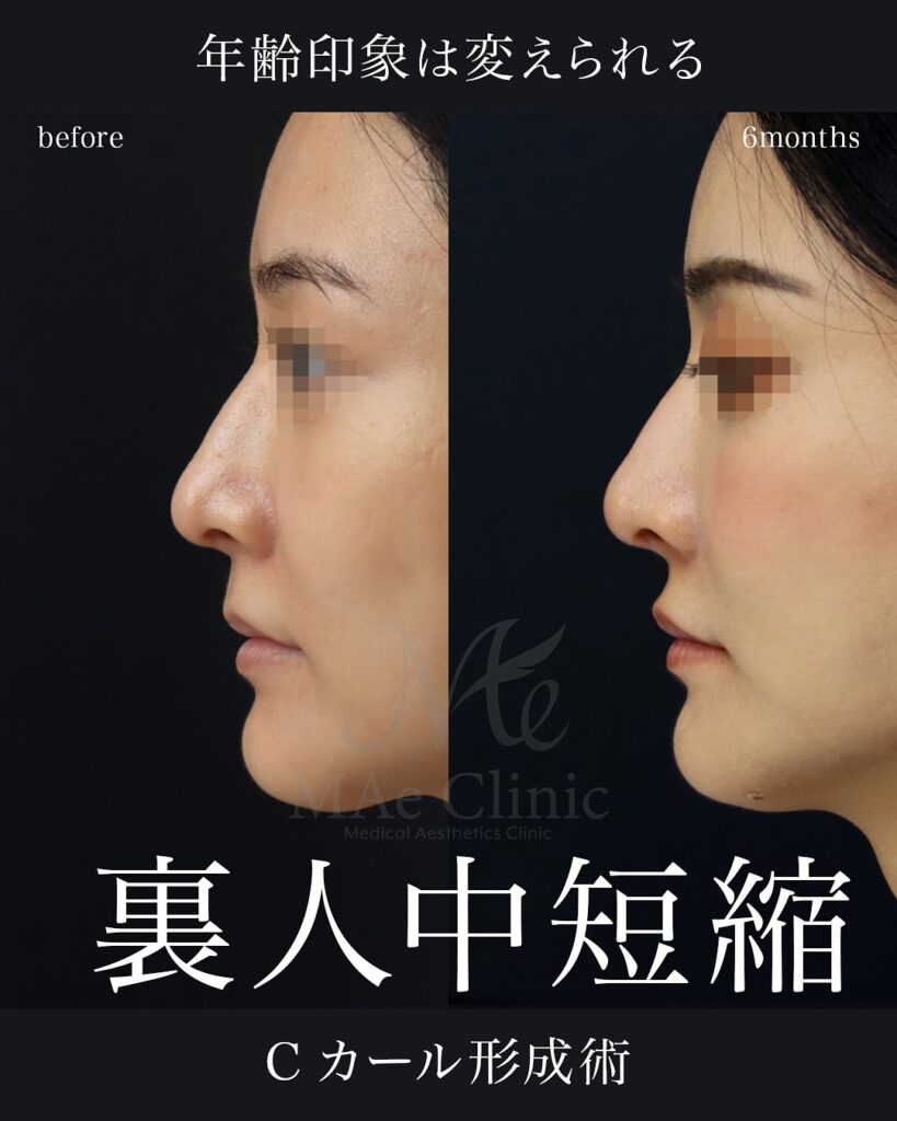 ・裏側人中短縮(傷の見えない人中短縮)
・人中厚み調整3D
前田翔医師 症例