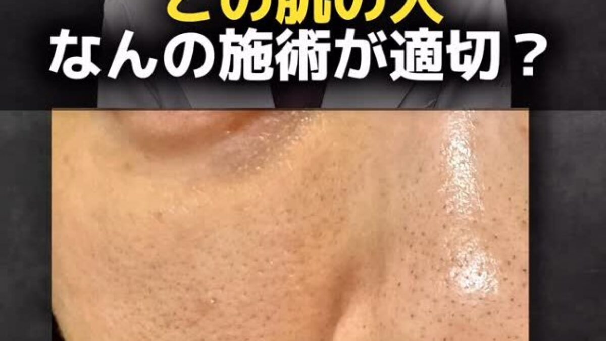 医師解説】黒ずみ毛穴・開き毛穴を根本から改善する3ステップ治療