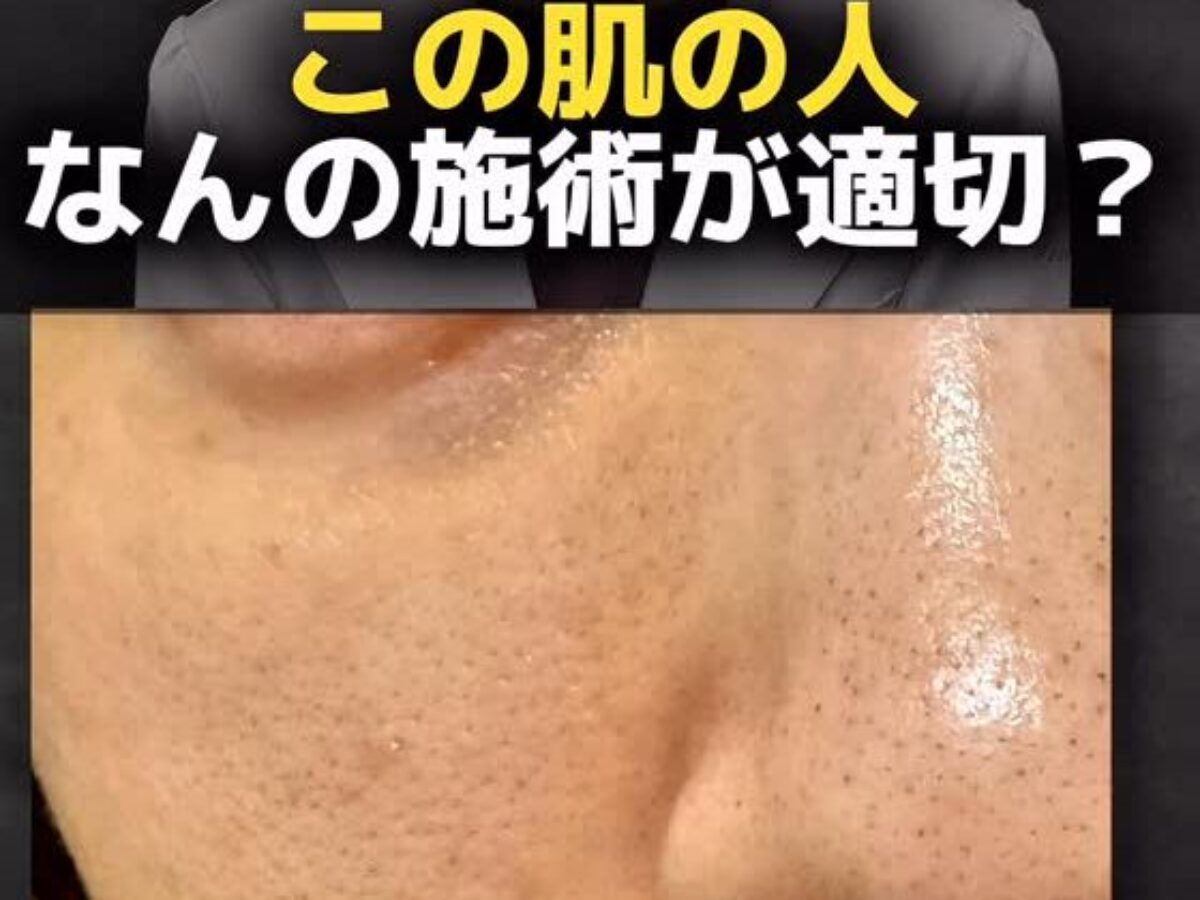 医師解説】黒ずみ毛穴・開き毛穴を根本から改善する3ステップ治療