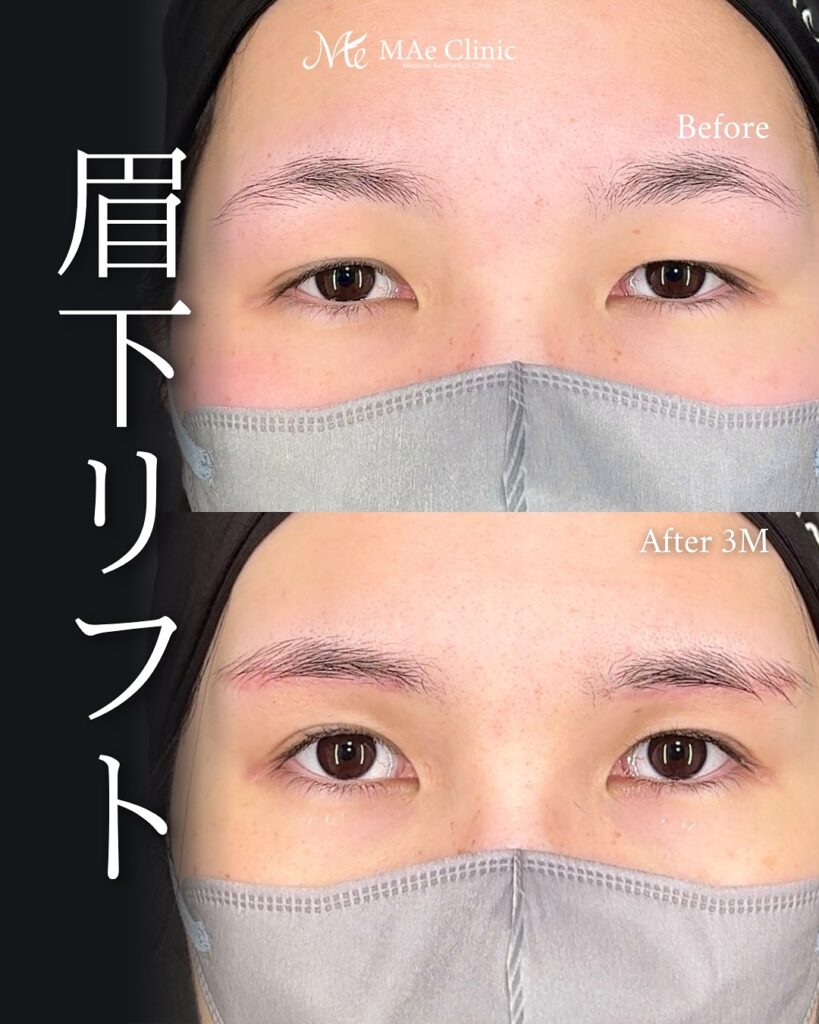 眉下リフト 前之園健太医師症例
