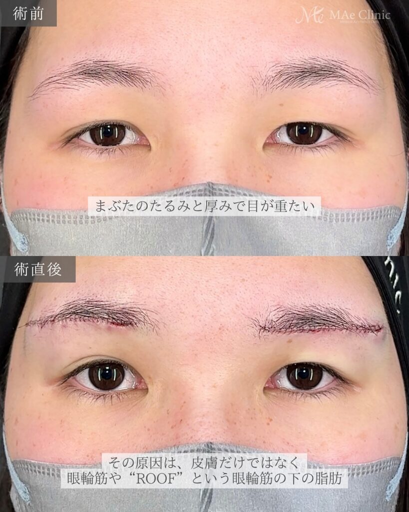 眉下リフト 前之園健太医師症例