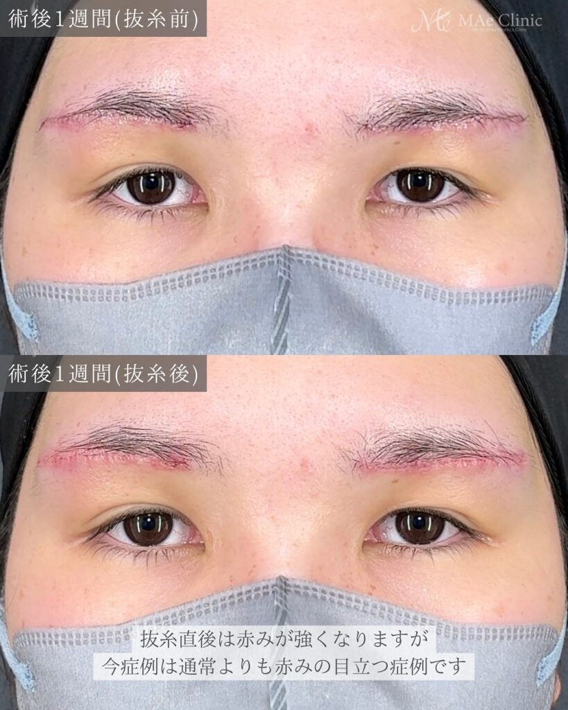 眉下リフト 前之園健太医師症例