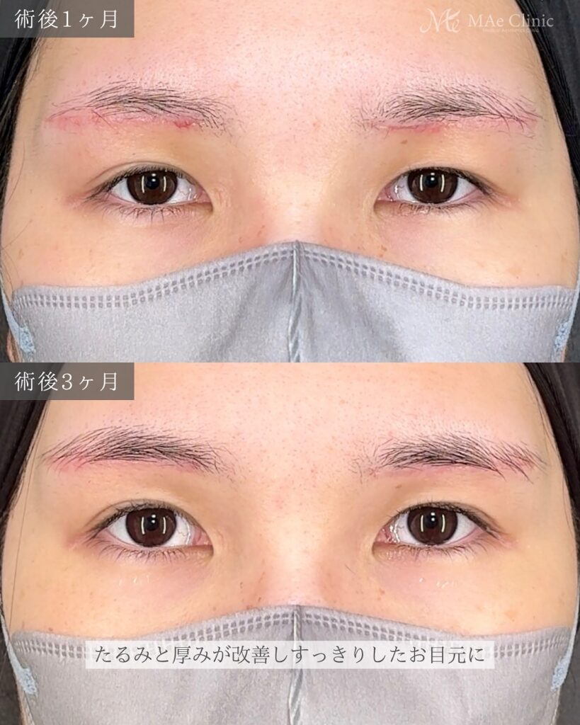 眉下リフト 前之園健太医師症例