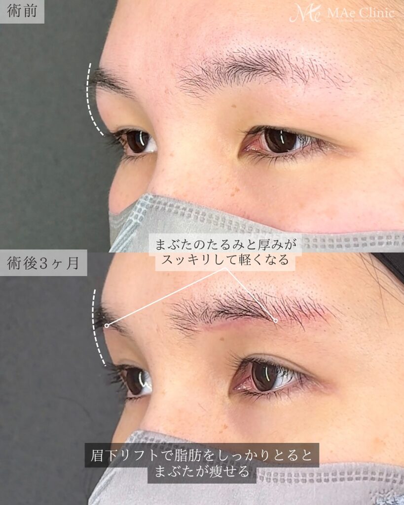 眉下リフト 前之園健太医師症例