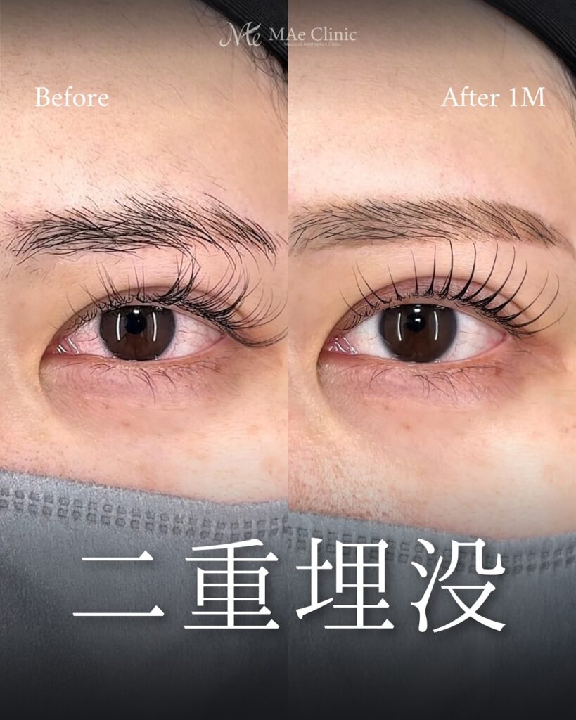 二重埋没(裏留め2ループ)
前之園健太医師症例