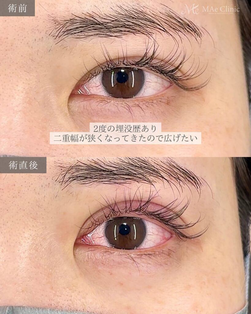 二重埋没(裏留め2ループ) 前之園健太医師症例