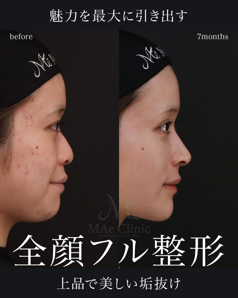 鼻フル(肋軟骨)
隆鼻術(肋軟骨)
鼻翼縮小(内+外)
貴族手術(肋軟骨)
Vライン+顎形成
埋没(裏留め)
目頭切開
裏ハムラ
口角挙上
脂肪吸引(頬)
前田翔医師症例