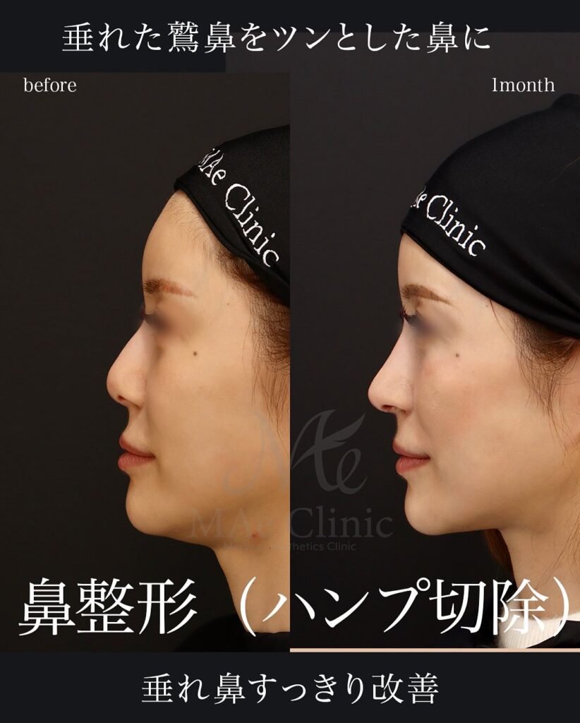 鼻中隔延長+ハンプ切除
望月正人医師症例