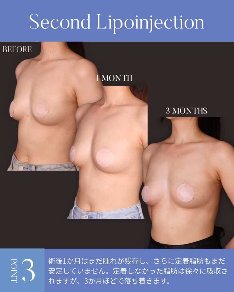 コンデンスリッチ脂肪豊胸(2回)木下恵里沙医師症例