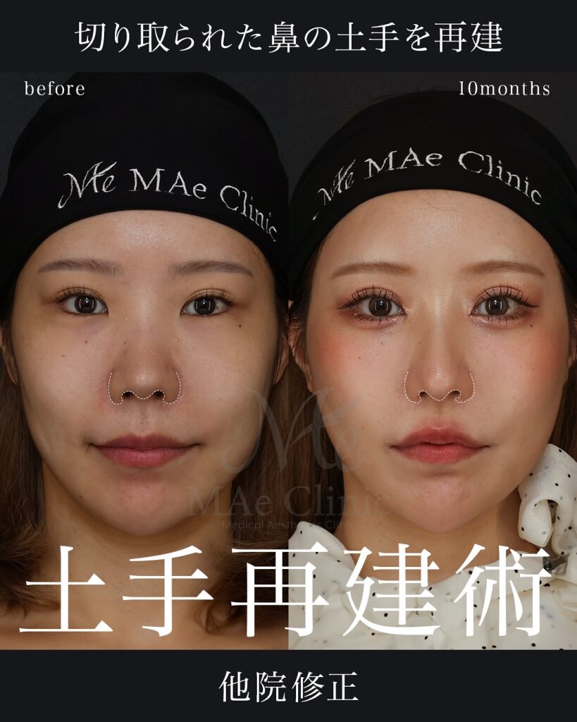 鼻尖形成+鼻尖軟骨移植+鼻柱下降+小鼻縮小(内+外)+貴族手術(肋軟骨)+裏人中短縮+3D厚み調整 前田翔医師症例