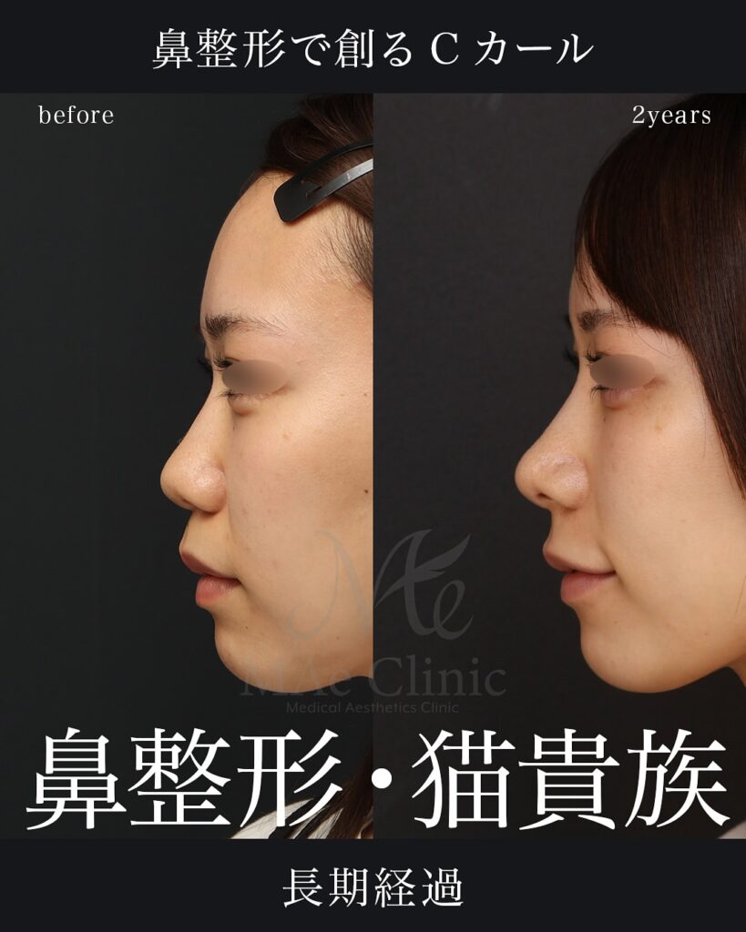鼻中隔延長(肋軟骨)+鼻尖形成+鼻尖軟骨移植+隆鼻術(肋軟骨)+猫貴族手術(肋軟骨)+脂肪注入(額)
前田翔医師症例