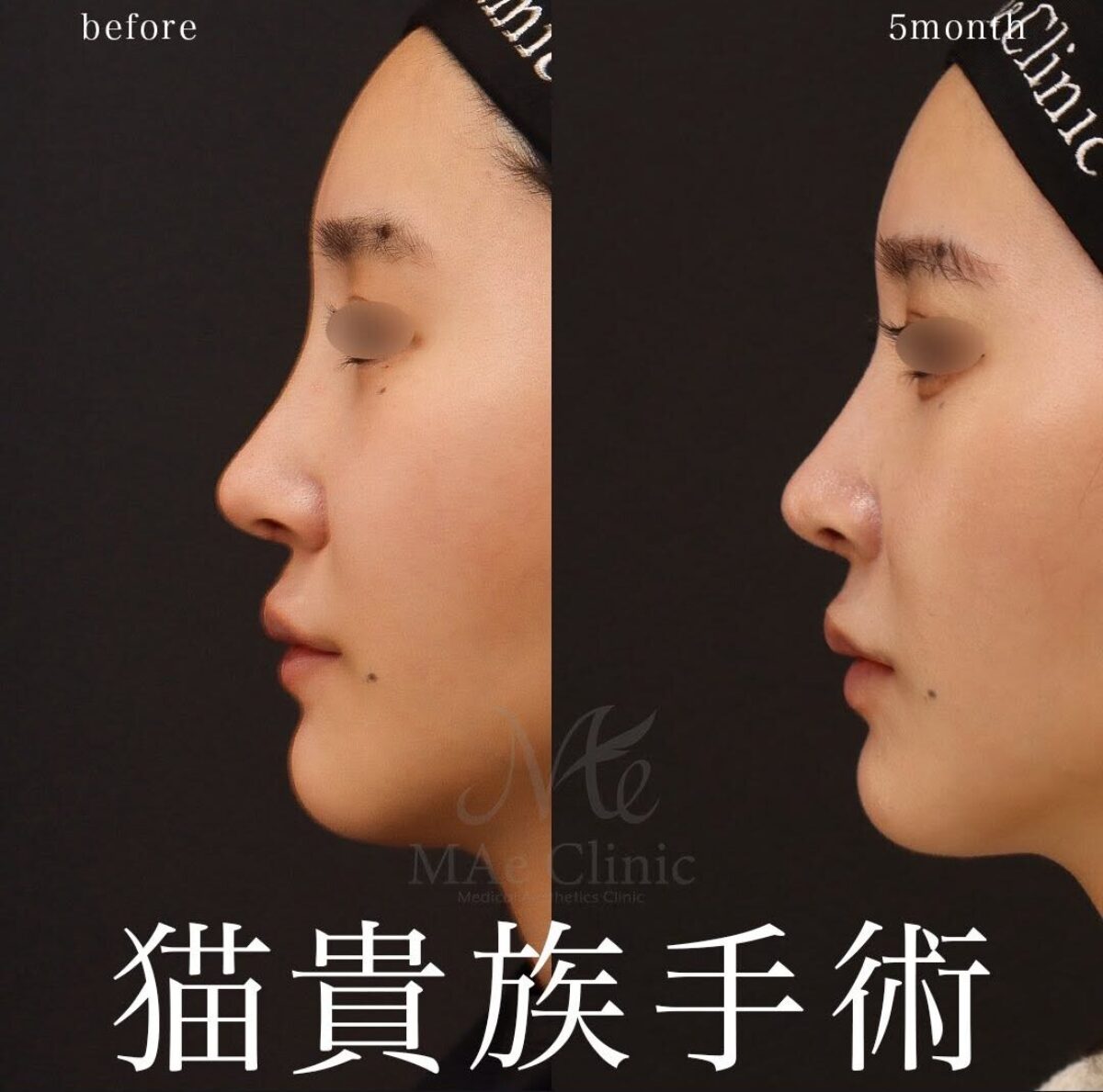 鼻整形なしでここまで変わる｜猫貴族手術のみで中顔面を立体的に整えた