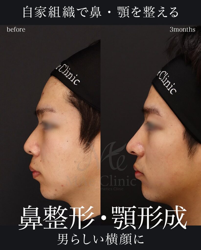 ▶ 鼻中隔延長(肋軟骨) ▶ 鼻尖形成 ▶ 鼻尖軟骨移植 ▶ 猫貴族手術(肋軟骨) ▶ 顎先軟骨移植 ▶ 自家組織隆鼻 望月正人医師症例