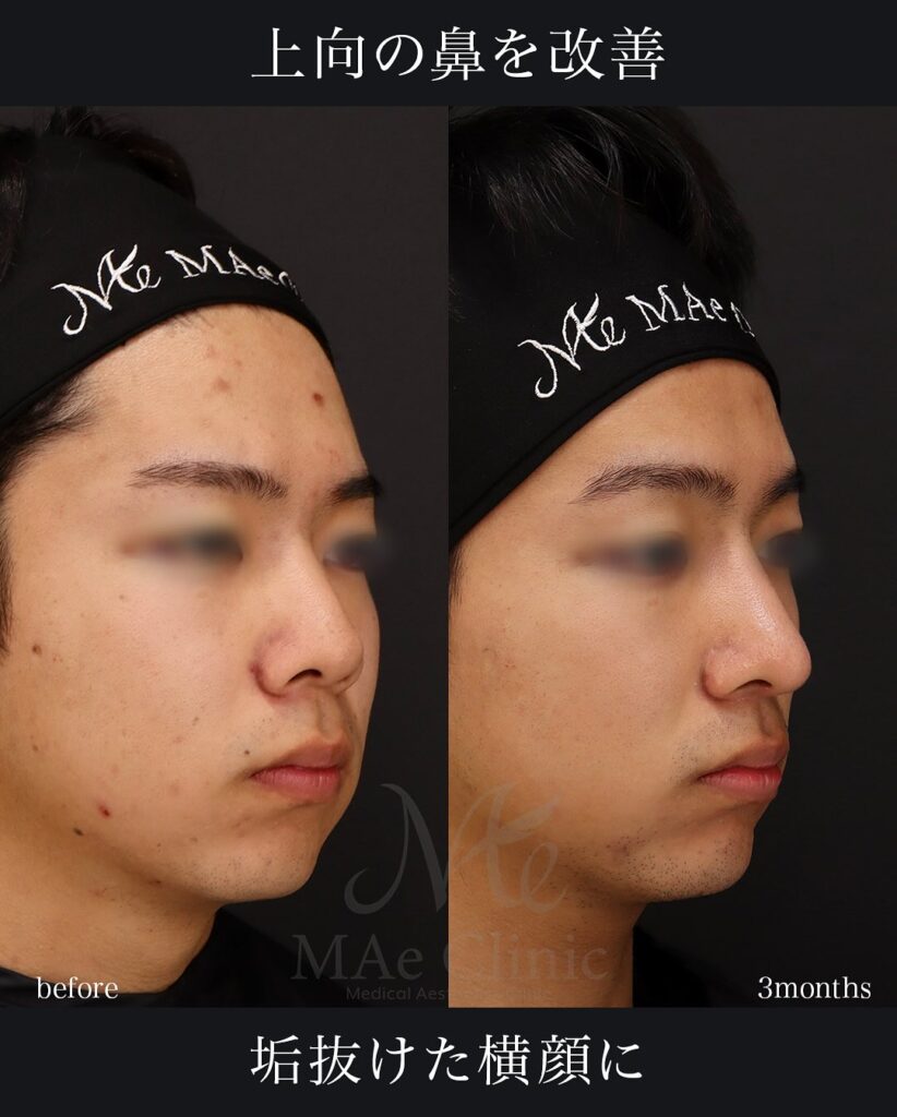 ▶ 鼻中隔延長(肋軟骨) ▶ 鼻尖形成 ▶ 鼻尖軟骨移植 ▶ 猫貴族手術(肋軟骨) ▶ 顎先軟骨移植 ▶ 自家組織隆鼻 望月正人医師症例