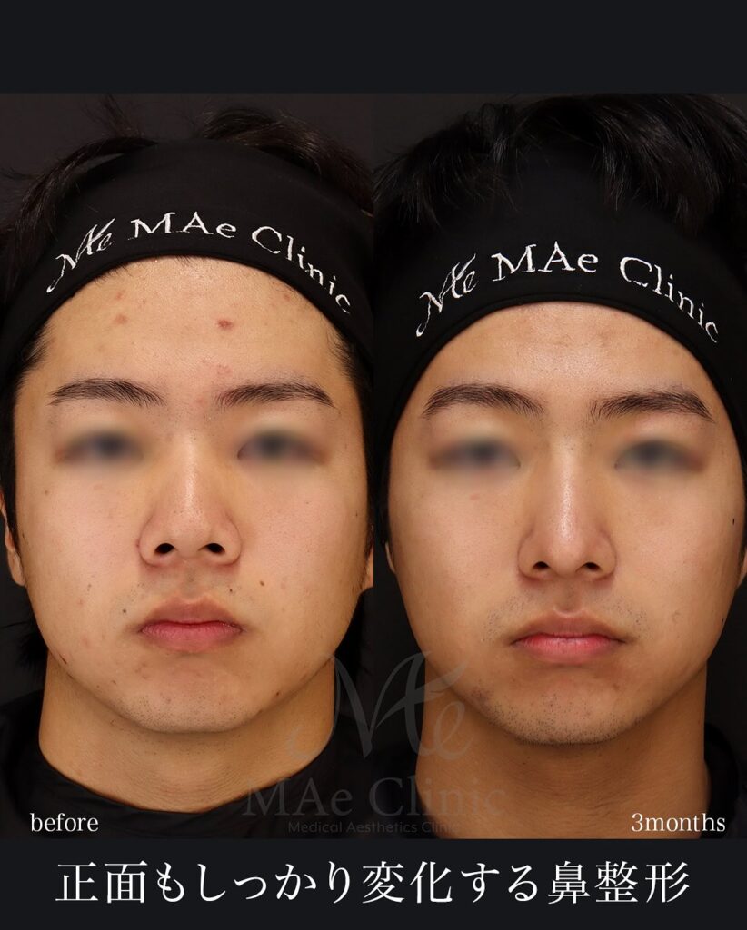 ▶ 鼻中隔延長(肋軟骨) ▶ 鼻尖形成 ▶ 鼻尖軟骨移植 ▶ 猫貴族手術(肋軟骨) ▶ 顎先軟骨移植 ▶ 自家組織隆鼻 望月正人医師症例