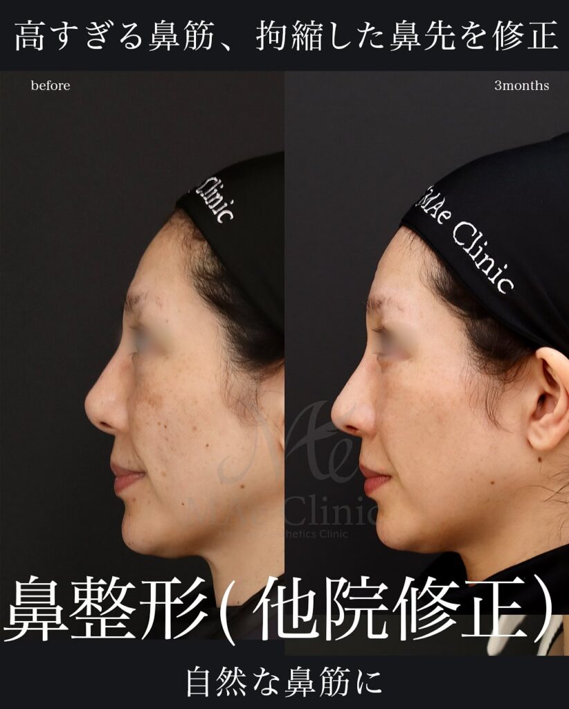 鼻中隔延長(肋軟骨)
鼻尖形成
鼻尖軟骨移植 望月正人医師症例