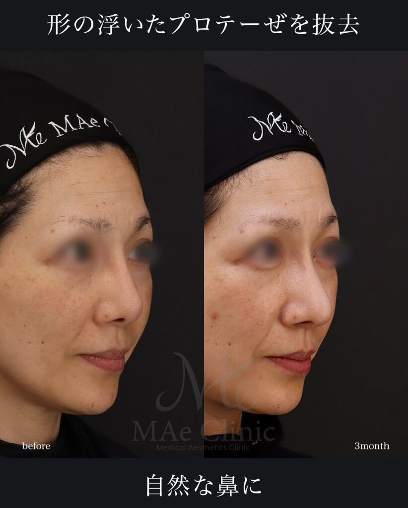 鼻中隔延長(肋軟骨) 鼻尖形成 鼻尖軟骨移植 望月正人医師症例