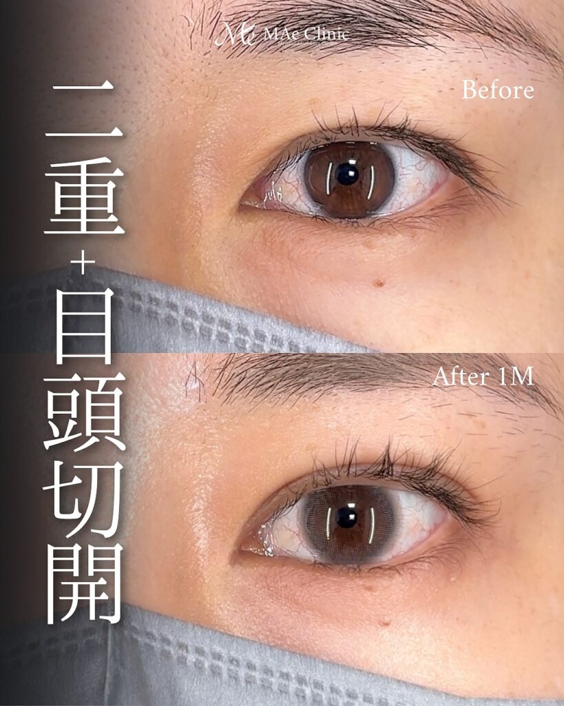 二重埋没(裏留め法) 目頭切開(リドレープ法) 前之園健太医師症例