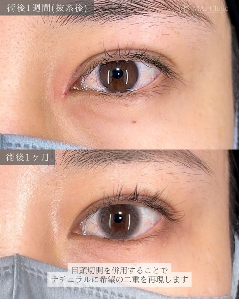 二重埋没(裏留め法) 目頭切開(リドレープ法) 前之園健太医師症例