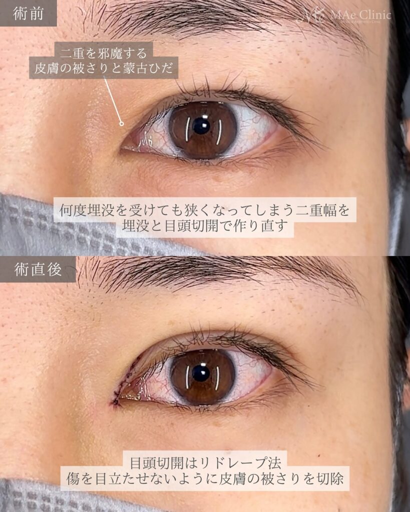 二重埋没(裏留め法) 目頭切開(リドレープ法) 前之園健太医師症例