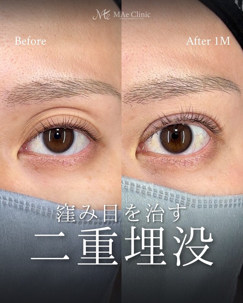 二重埋没(裏留め2ループ法)術後1ヵ月 前之園健太医師症例