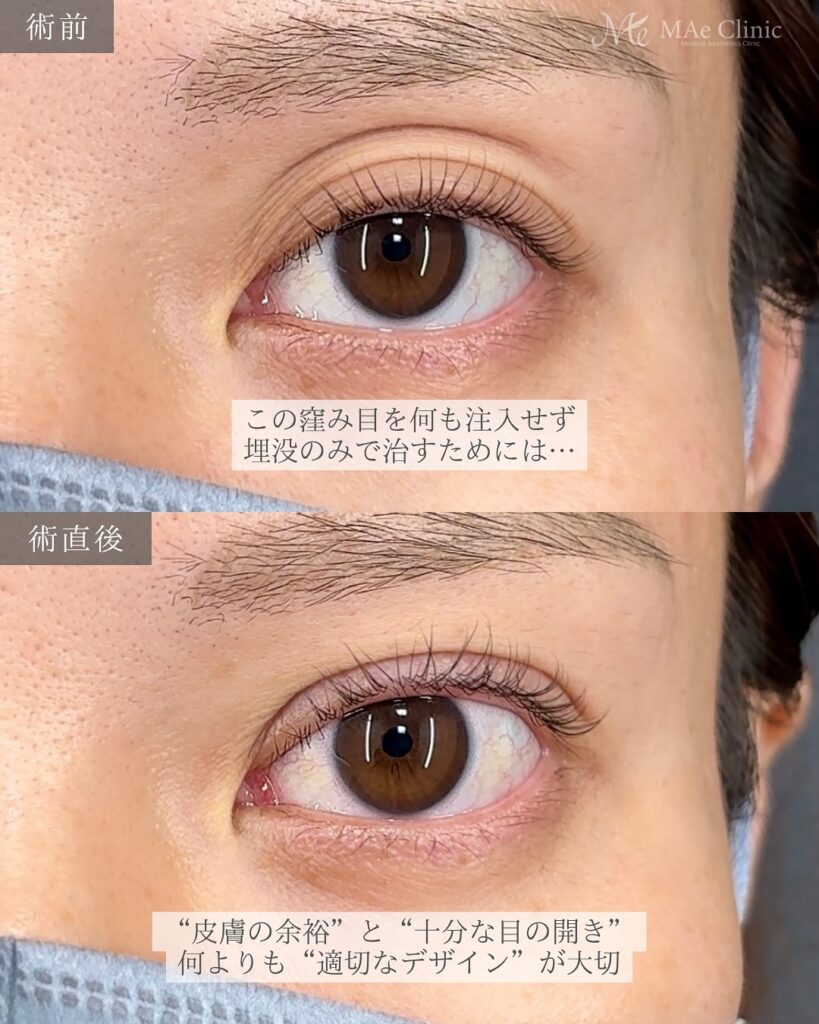 二重埋没(裏留め2ループ法)術後1ヵ月 前之園健太医師症例