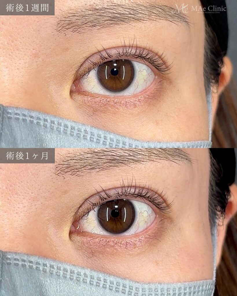 二重埋没(裏留め2ループ法)術後1ヵ月 前之園健太医師症例