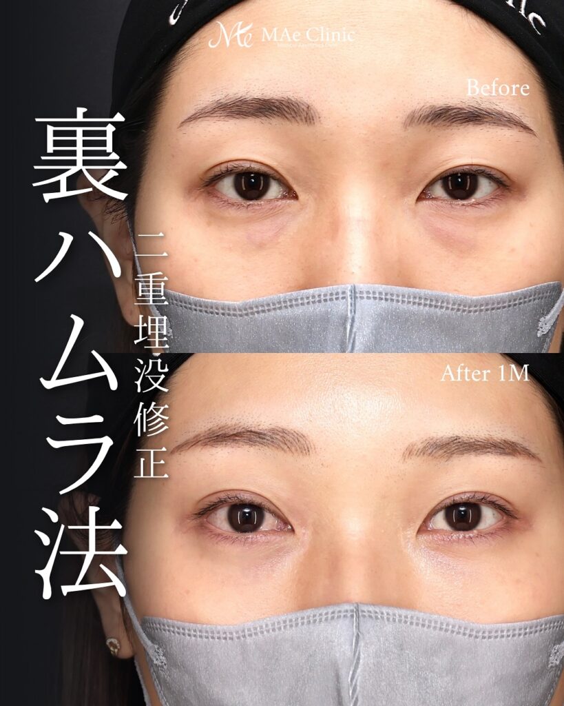 裏ハムラ法(経結膜下眼瞼形成術) 埋没法修正 前之園健太医師症例