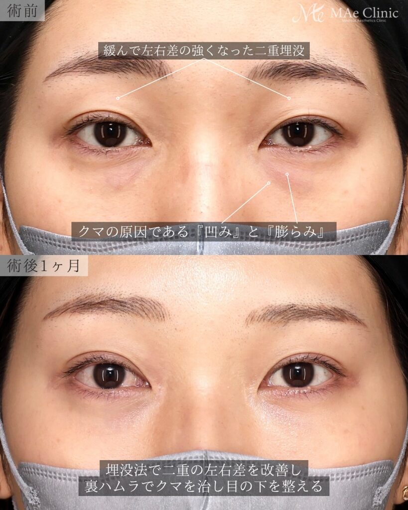 裏ハムラ法(経結膜下眼瞼形成術) 埋没法修正 前之園健太医師症例