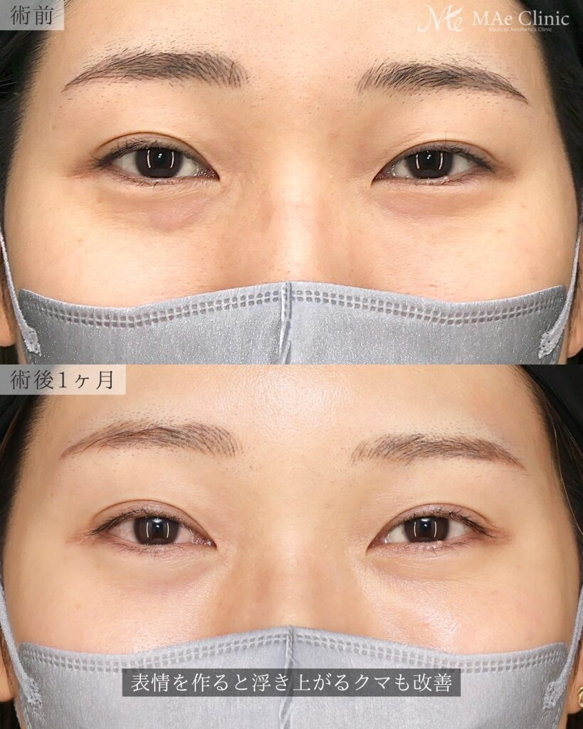 裏ハムラ法(経結膜下眼瞼形成術) 埋没法修正 前之園健太医師症例