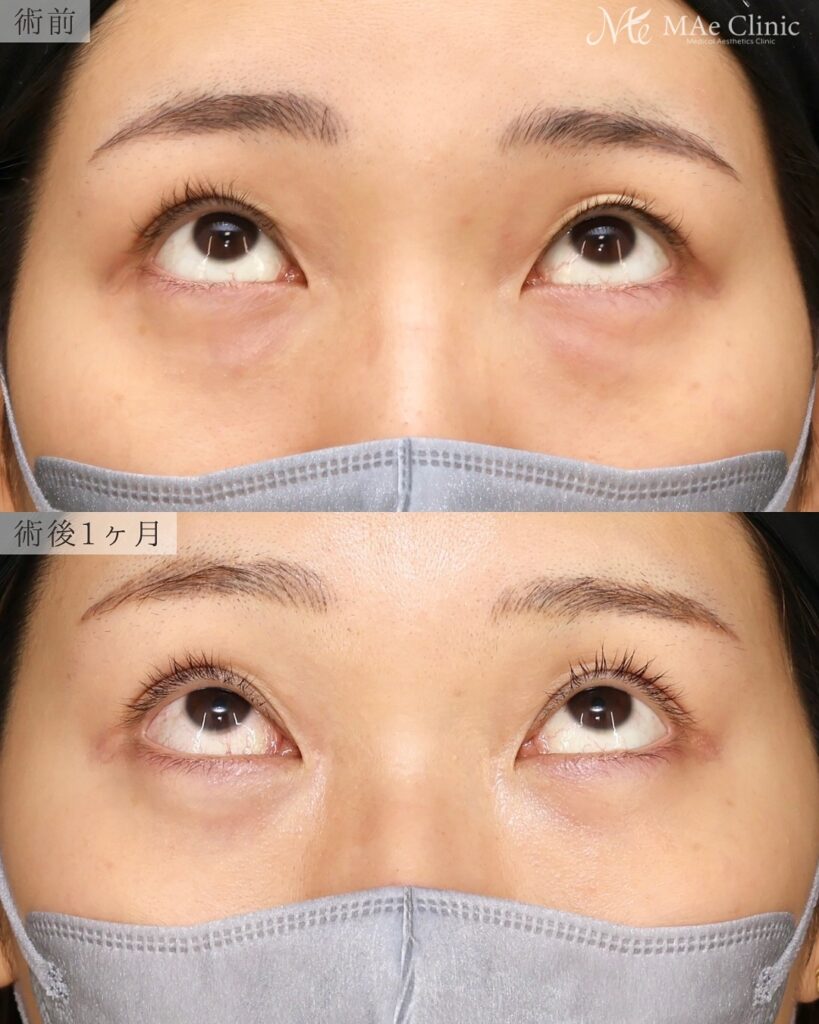 裏ハムラ法(経結膜下眼瞼形成術) 埋没法修正 前之園健太医師症例